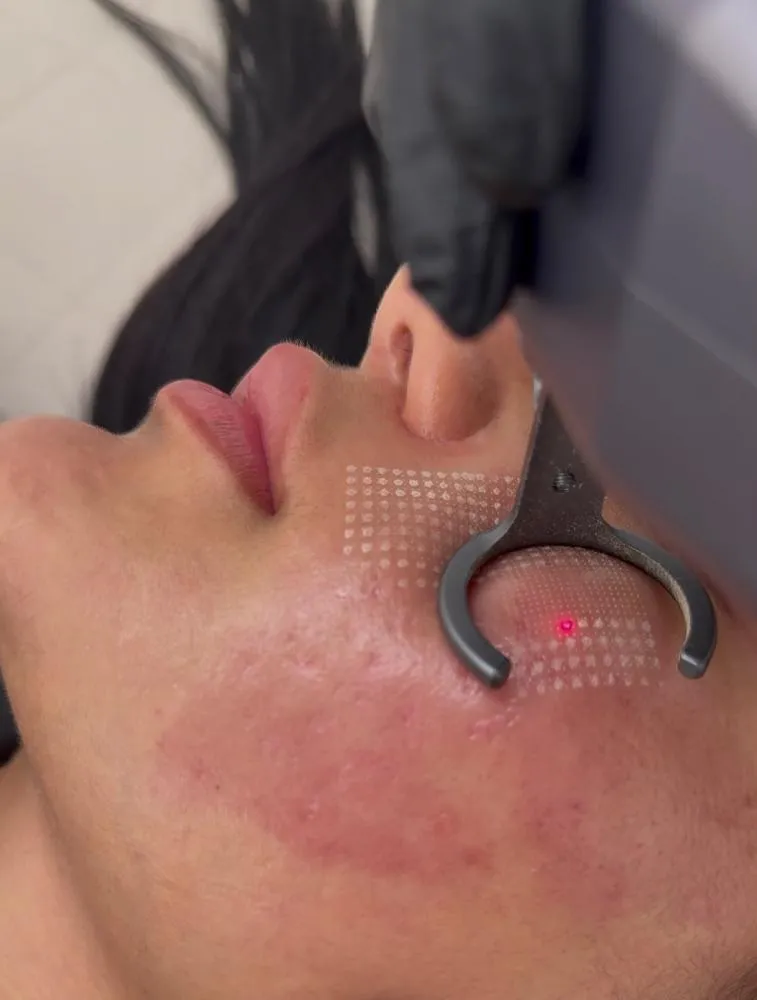 A febre do Laser CO₂ com Microcoring